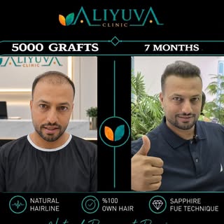 From visible hair thinning to a fuller and more confident appearance...

After a 5000-graft hair tra