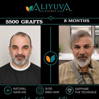 An impressive 8-month hair transplant result for our patient from Iraq after 5500 grafts at Ali Yuva