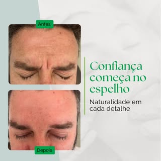 Esse é o tipo de resultado que a gente busca: uma melhora que aparece, mas que não grita.

O botox a