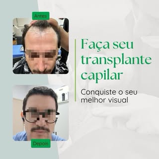 Transplante capilar não é só sobre volume. É sobre recuperar a confiança, o penteado que você gostav