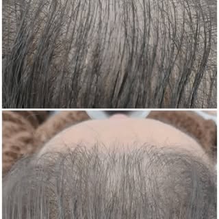 Regeneração capilar!!! 

Com a tecnologia dos exossomos, peptídeos e Pdrn nos protocolos de recupera