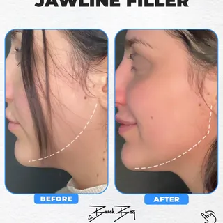 Before–after results in jawline filler may vary from person to person.
Before: 24.01.2024 — After: 0