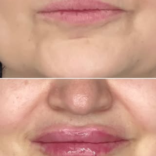 Before–after results in lip filler may vary from person to person.
Before: 07.02.2024 — After: 16.02