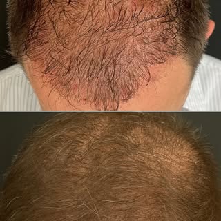 Before–after results in hair mesotherapy may vary from person to person. Before: 23.03.2026 — After: