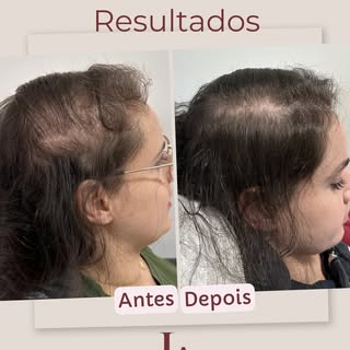 Paciente jovem que sofre há algum tempo com alopecia fibrosante, conseguimos estabilizar e estamos r