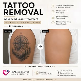 ✨ Ready for a Fresh Start? Advanced Tattoo Removal in Gurugram ✨

Your tattoo may have been right fo