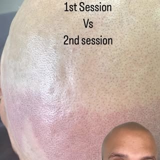 1st session VS 2nd Session

#scalp #micropigmentation #smp #scalpmicropigmentation #bald #balding #i