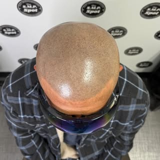 ZOOMED in view of SMP. 

#scalp #micropigmentation #smp #scalpmicropigmentation #bald #balding #inst