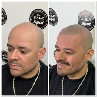 Scalp micropigmentation. 2 sessions is all it takes. Some opt for 3, but this was immediately after 