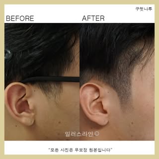 과거에 탈모는 나이든 
남자에게만 주로
나타나는 증상이였죠.

하지만 현재에 들어서는
남녀 상관없이 탈모가 진행되며
서구화된 식습관과 환경적 요소가 더해져
유전적인 요소가 없어도 