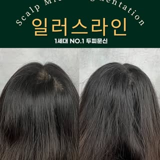 정수리 스트레스로 인한 탈모
완벽히 해결해드렸습니다!
_________________________

강남 일러스라인 대표도 받았습니다!

예약 문의는 프로필 상단에 
카카오채널이
