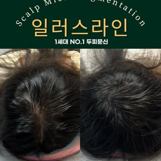 정수리 두피문신 후
고객님이 업드려 계실때
찍은 전후 모습입니다.
갈라지는 가르마부터
정수리까지 자연스럽게😌
_________________________

강남 일러스라인 대표