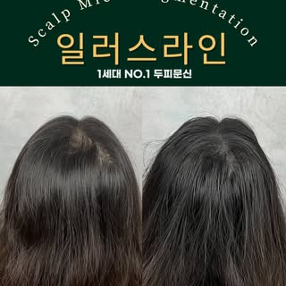 정수리 탈모 스트레스
해결해드렸습니다! 
바빠서 게시글 올릴 시간이..
_________________________

강남 일러스라인 대표도 받았습니다!

예약 문의는 프로필 상