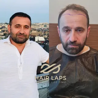 Hair transplant surgery has become a priority choice to those who are anxious to restore their hair 