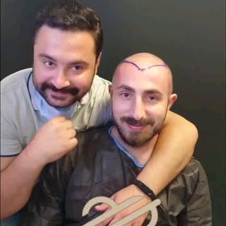 Hair transplant surgery has become a priority choice to those who are anxious to restore their hair 