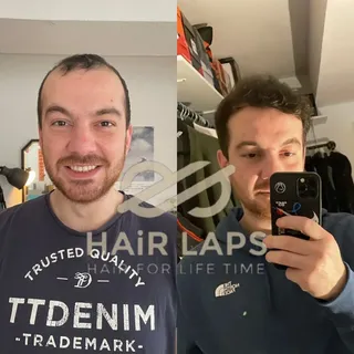 Hair transplant surgery has become a priority choice to those who are anxious to restore their hair 