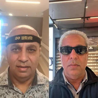 Hair transplant surgery has become a priority choice to those who are anxious to restore their hair 