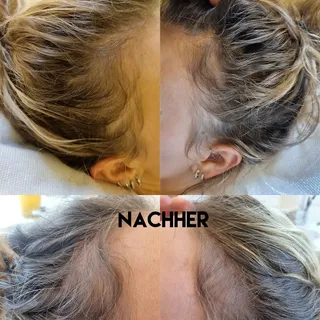 Ergebnis nach der 2.PRP-Behandlung

#dermatology #dermatologie#swiss #schweiz#zürich #wallisellen #p