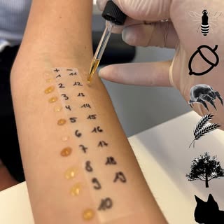 Der Pricktest ist ein Hauttest, mit dem bestimmte durch Immunglobulin E vermittelte Allergien nachge