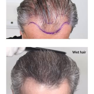 Dr. Espinosa Custodio is 100% involved in the surgery, both in the extraction and implantation of th