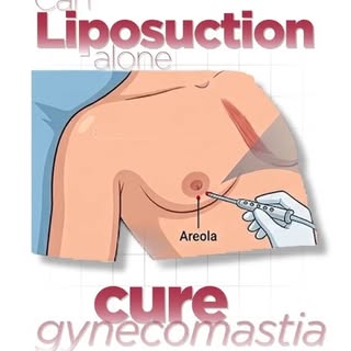 Planning gynecomastia surgery in Pune? Here I, Dr. Salil Patil, a gyno surgeon in Pune, reveal why l