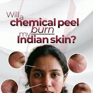 Will a chemical peel burn Indian skin? This one question stops thousands of people from trying one o