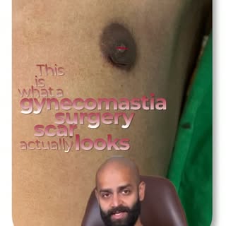 What does a gynecomastia surgery scar ACTUALLY look like? Most guys searching this are worried about
