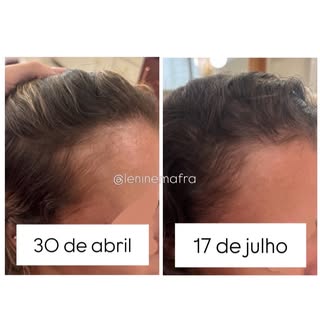 Queda de cabelo nem sempre começa no couro cabeludo. E esse caso é um exemplo disso.

Essa paciente 