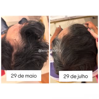 Nem toda alopecia começa com “muito cabelo caindo”. Muitas vezes, o primeiro sinal é o afinamento do