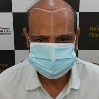 5000 Grafts FUE Hair Transplant — Precision, Density & Natural-Looking Results.

.

.

.

.
.

.
.
.