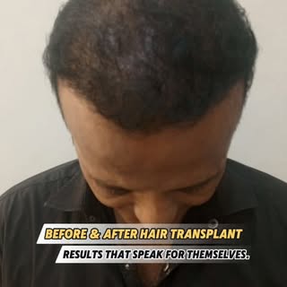 carefully planned restoration designed to rebuild the hairline and improve overall hair density with