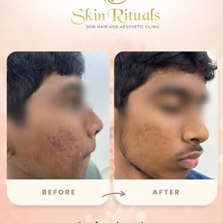From breakouts to breakthroughs. 

Professional acne treatment that actually works.

 Dr. Kadari Yas