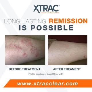 Say hello to clearer skin with XTRAC!
The XTRAC laser is a cutting-edge treatment for psoriasis, vit