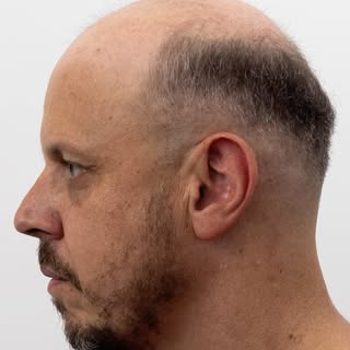 Watch confidence come back in under 30 seconds. ❤️

✨ Hair loss doesn’t define you, and you don’t ha
