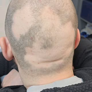 Check out my Alopecia client i did today! You don’t have to keep dealing with that. 

Imagine lookin