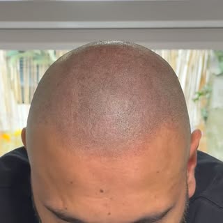 When a hair transplant goes wrong or isn’t what you thought it was going to be SMP can really improv