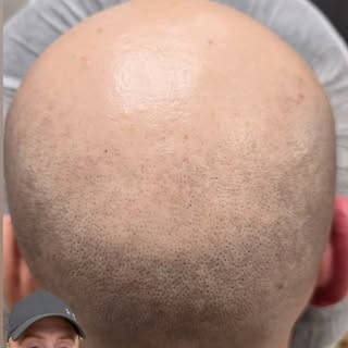 Say good bye to that horse shoe once and for all!! SMP is the perfect way to embrace a shaved head a