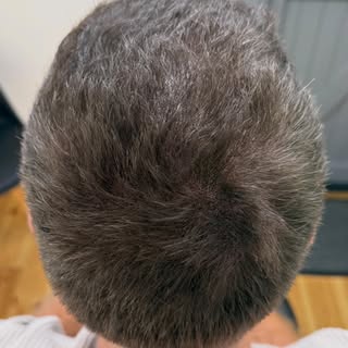 Failed HairTransplant and after 2 weeks can add density for thickness, I also added SMP to the FUR s