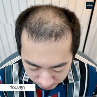 คนไข้มาด้วยปัญหาผมบางเป็นหลักและแนวผมเริ่มเว้าลึกขยายเป็นวงกว้าง เคยหาวิธีรักษามาหลายวิธีสุดท้ายตัดส