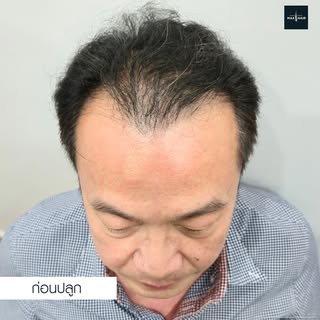 ปัญหาผมร่วงบาง ปรึกษาคุณหมอที่ Max Hair ได้เลยค่าา เคสนี้ปลูกผมแก้ไขแนวที่ขยายเป็นวงกว้าง หลังปลูกคร