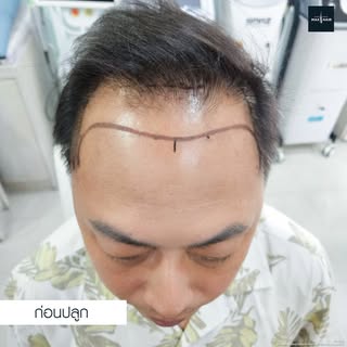 ปลูกผมเพื่อปรับกรอบหน้าให้ดูอ่อนเยาว์ พร้อมออกแบบแนวไรผมให้รับกับรูปหน้าและสไตล์ของคนไข้แต่ละคน เคสน