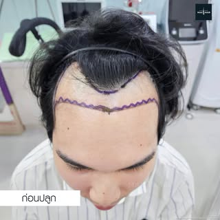 จากปัญหาผมบางและแนวผมที่ถอยลงเรื่อย ๆ ทำให้ใบหน้าเปลี่ยนไปและความมั่นใจลดลง คนไข้จึงเลือกเข้ามาปรึกษ