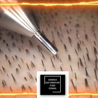 "No more hiding under hats – let your confidence shine!

https://www.advancedhairtransplantclinic.co