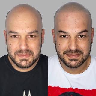 Before → After ✨

For years, this client never felt comfortable without a cap. After this life-chang