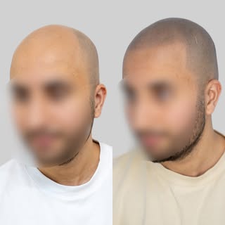 Before → After ✨

A subtle change. A huge difference.

Today, we gave our client who prefers to rema