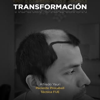 ¡Miren este resultado increíble! 🤩 Alfredo Yauri recuperó su cabello con la técnica #FUE en #Procab