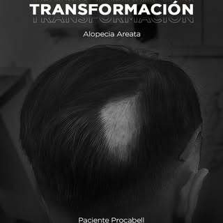 Un Caso de Éxito Definitivo 😉
Sabemos que enfrentar la pérdida de cabello puede ser un proceso difí