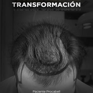 El poder de un cambio real
Cuando la tecnología de última generación se une con manos expertas, los 