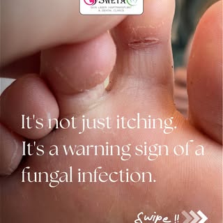 It's not just itching. It's a warning sign of a fungal infection. 👣

Athlete's foot happens when fu