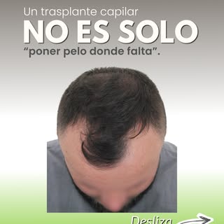 Un trasplante capilar no es simplemente “poner pelo donde falta”. Es una cirugía que requiere planif
